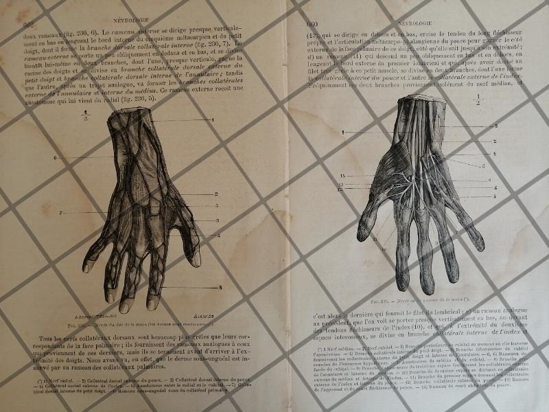 GRABADO MEDICO ANTIGUO 1877 NERVIOS EN MANOS /03